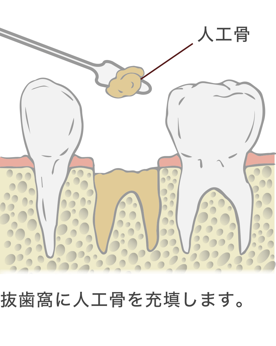 抜歯窩に人工骨を充填します。