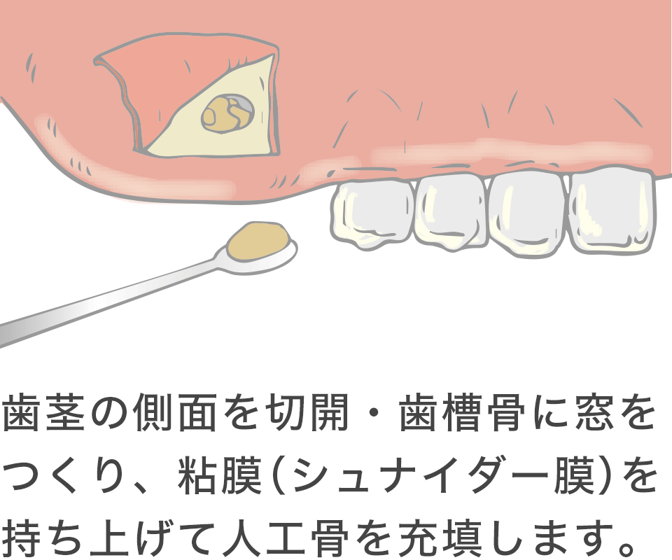 歯茎の側面を切開・歯槽骨に窓をつくり、粘膜（シュナイダー膜）を持ち上げて人工骨を充填します。